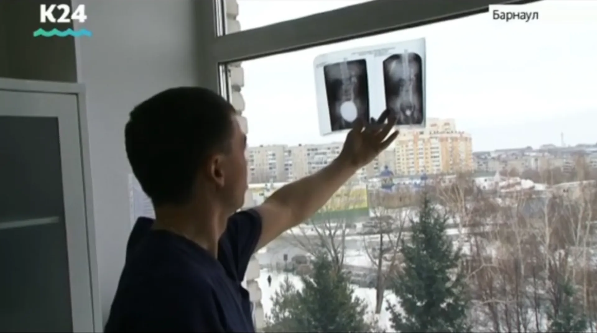 Уникальную операцию по пересадке мочеточника провели алтайские врачи 
