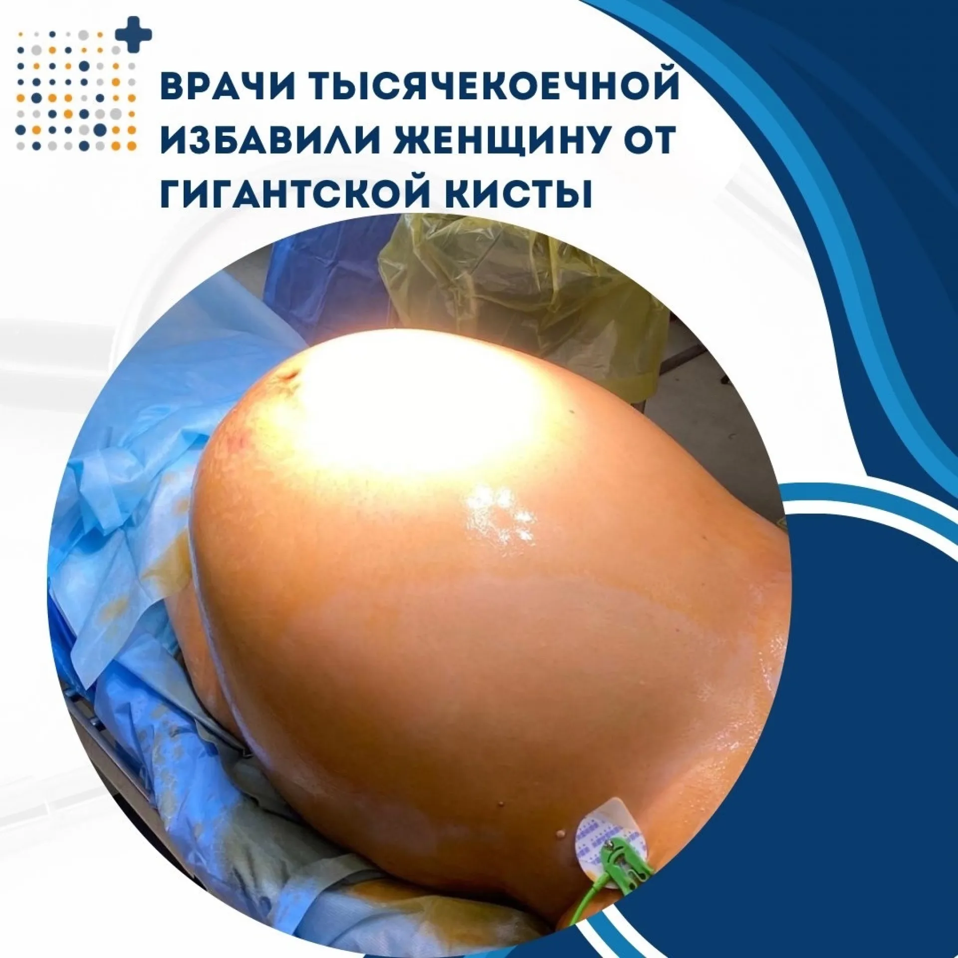 39-килограммовую опухоль яичника удалили у пациентки во Владивостоке 39-килограммовую опухоль яичника удалили у пациентки во Владивостоке