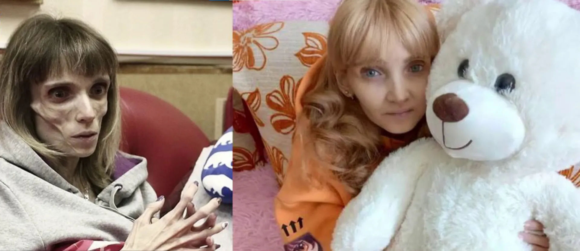 Жительница Барнаула, весившая в 23 года 17 килограмм, возвращается к обычной жизни Жительница Барнаула, весившая в 23 года 17 килограмм, возвращается к обычной жизни